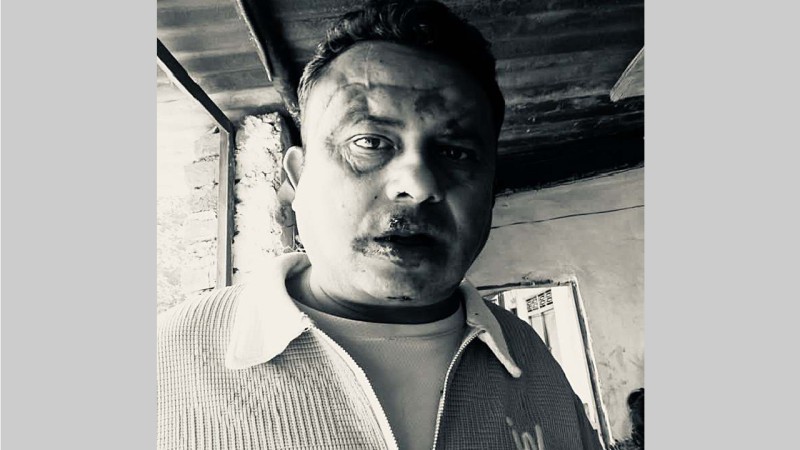 दाङको तुलसीपुरमा दाङ भ्यालीका अटो चालकको कुटपिटबाट नमस्तेका अटो चालक घाइते